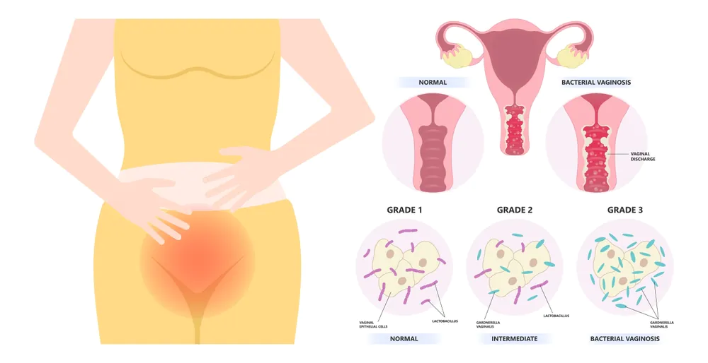 प्रेगनेंसी में वाइट डिस्चार्ज होना