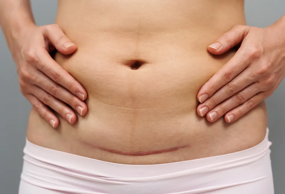 सिजेरियन डिलीवरी के बाद टांके में दर्द