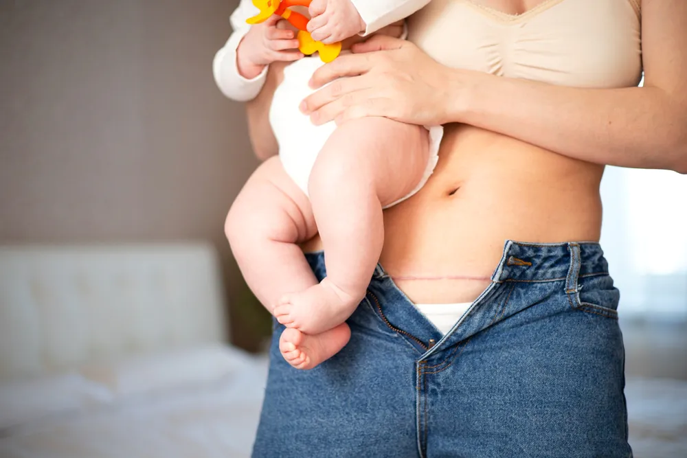 सिजेरियन डिलीवरी के कितने दिन बाद पीरियड आता है