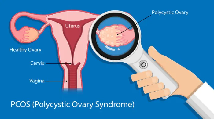 PCOS Kya Hota Hai (Polycystic Ovarian Syndrome) पीसीओएस क्या होता है?